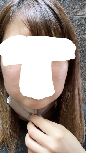 after photo: 脂肪溶解注射(顔)