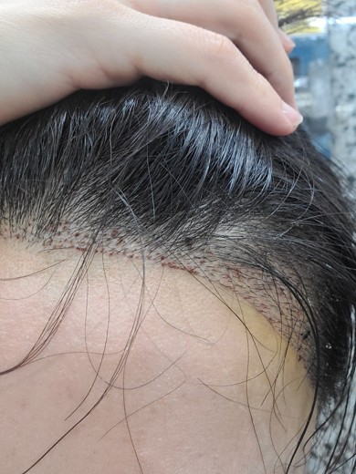 after photo: 머리모발이식