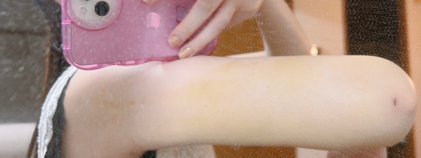 after photo: 脂肪吸引(腕)
