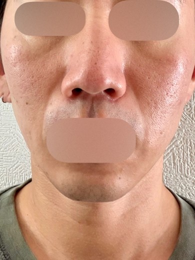 after photo: ダーマペン