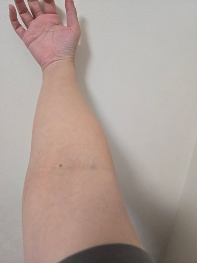 after photo: 白玉注射・点滴, 美容注射・点滴