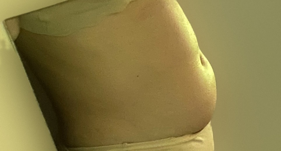 before photo: 복부지방흡입