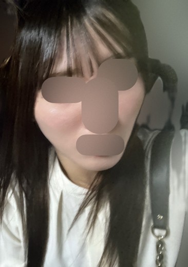 after photo: ララピール(LHAピーリング)