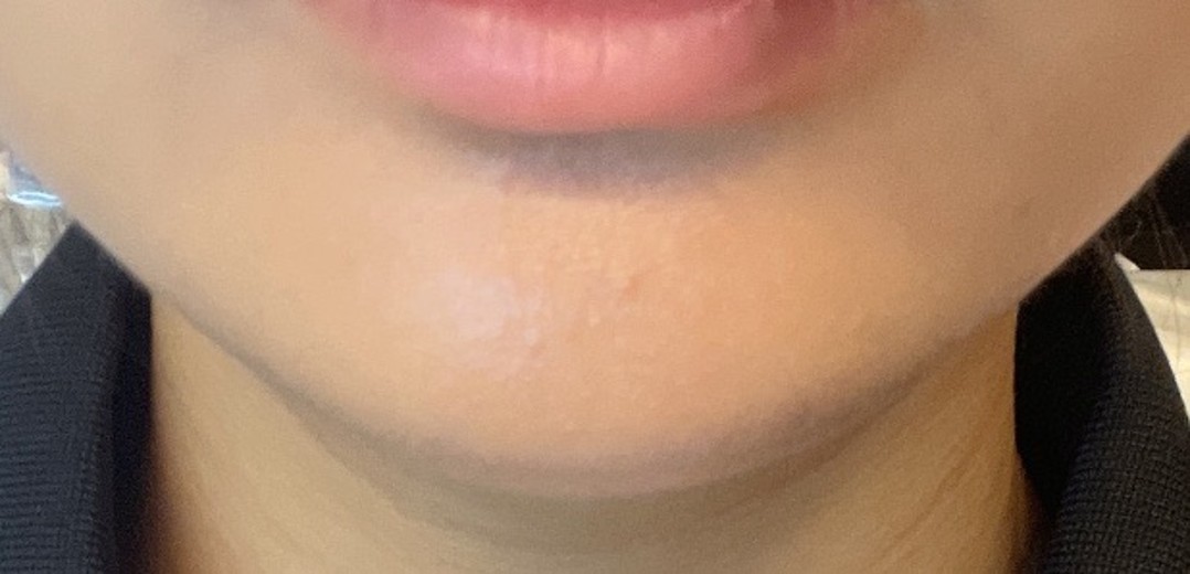 after photo: 인모드리프팅