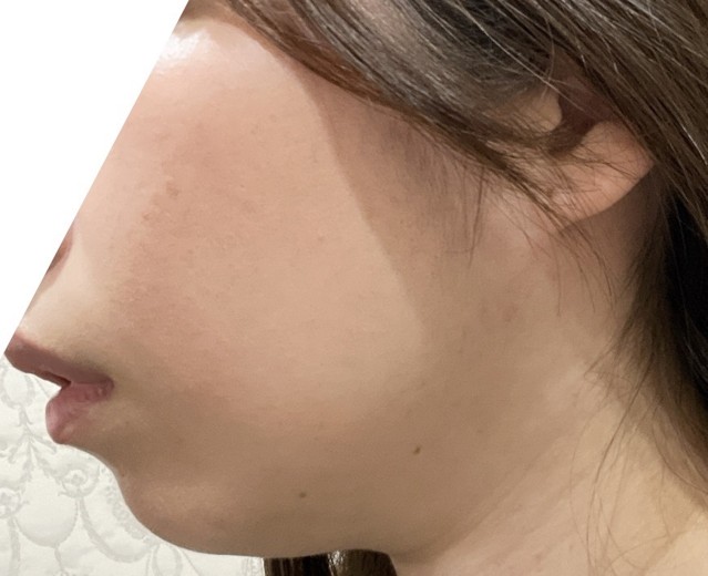 before photo: 脂肪溶解注射(顔)