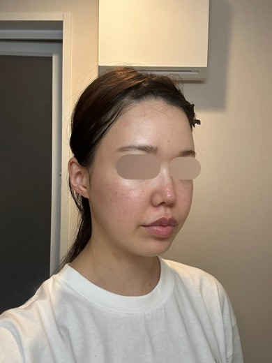before photo: IPL(光/フォト治療)