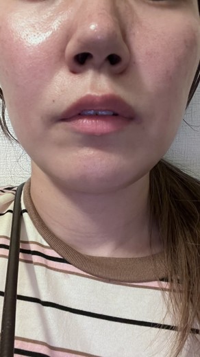 after photo: ジュベルック(Juvelook)