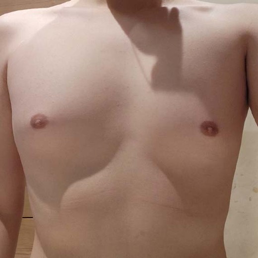 before photo: 여유증수술