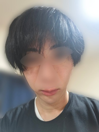 after photo: ポテンツァ(POTENZA), 診断・検査, ジュベルック(Juvelook)