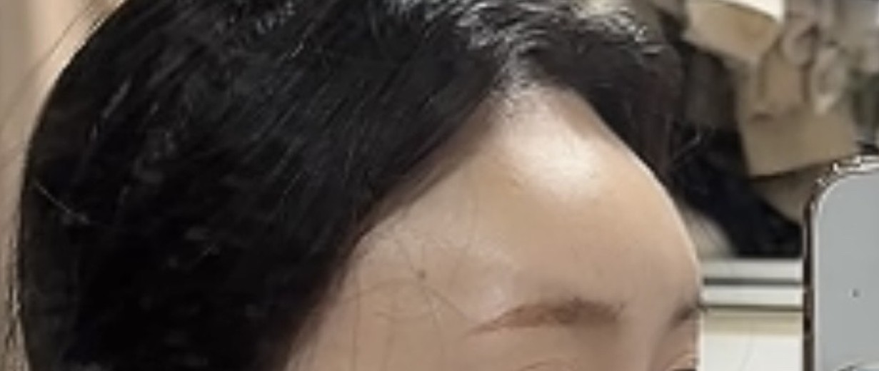 before photo: 이마필러