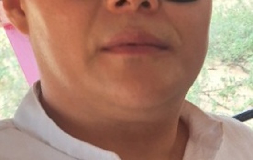 before photo: 이중턱지방흡입, 이중턱근육묶기