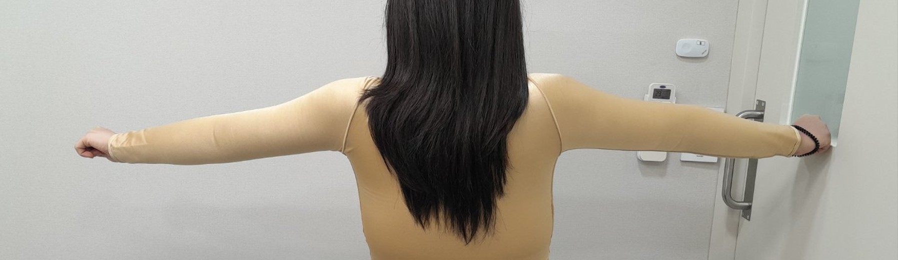 after photo: 脂肪吸引(腕)
