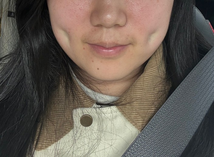 after photo: 보조개성형