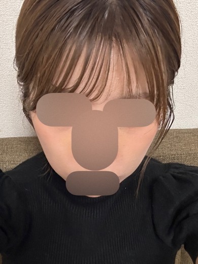 after photo: 美容注射・点滴