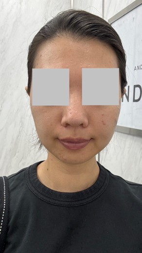 after photo: イオン導入