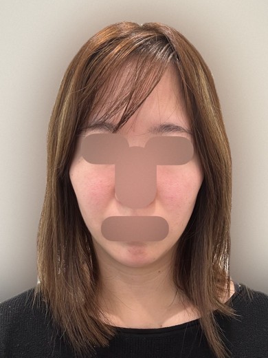 before photo: ハイドラフェイシャル