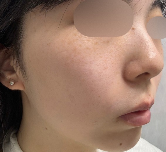before photo: ハイドラフェイシャル