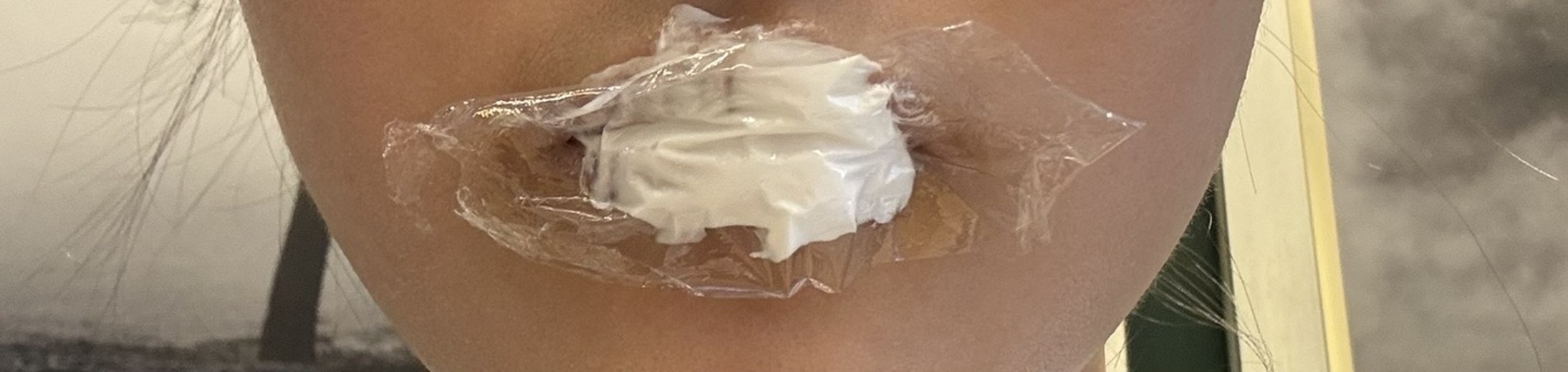 after photo: 입꼬리필러, 입술필러