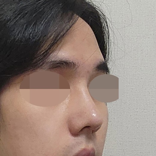 after photo: 코끝(자가연골)