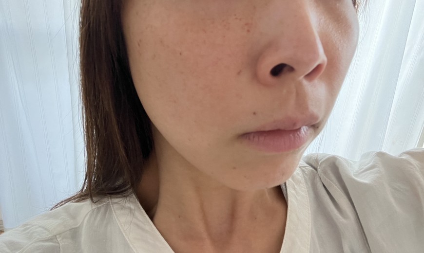 after photo: ピコトーニング, ピコフラクショナル