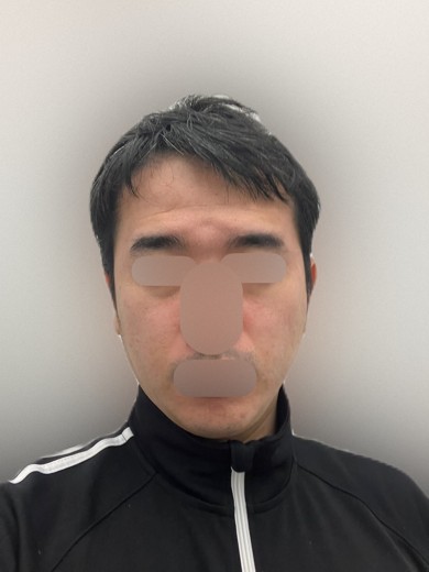 after photo: 白玉注射・点滴