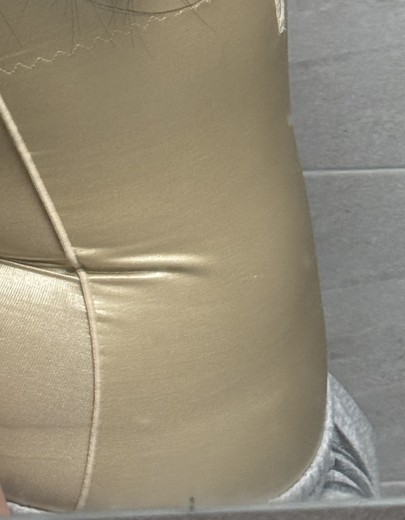 after photo: 팔지방흡입, 옆구리지방흡입, 복부지방흡입, 허리지방흡입