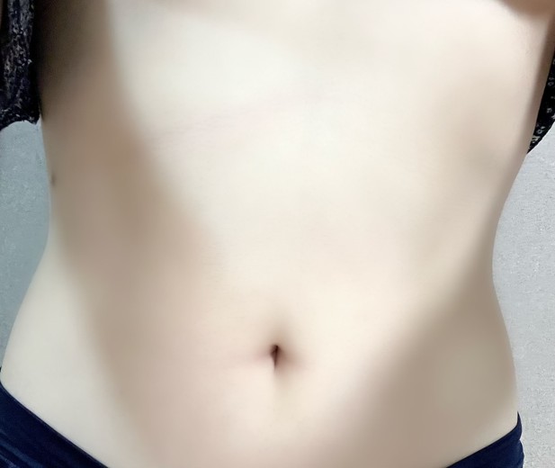 after photo: 脂肪冷却(腹部)