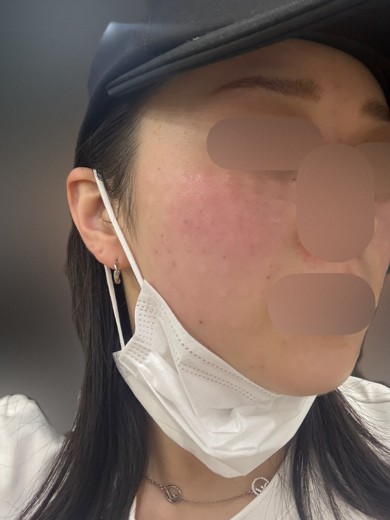 after photo: ララピール(LHAピーリング)