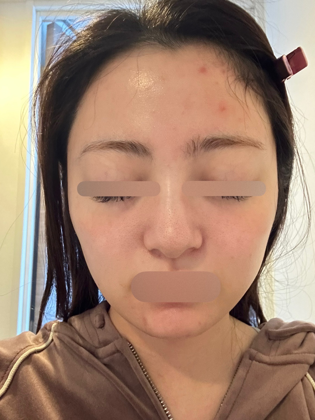 Hello face ダウンタイム腫れケアライト KOライト｜ダウンタイム軽減｜エイジングケア｜ニキビ｜LED治療