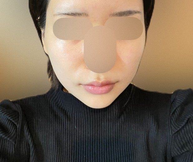 before photo: 糸リフト