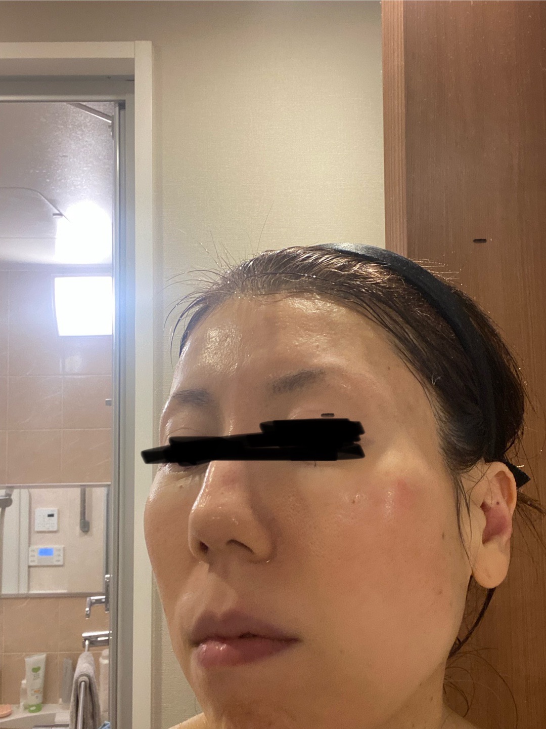 IPL（光治療）全顔2周 ｜ステラM22フォトフェイシャル【12月15日迄にご