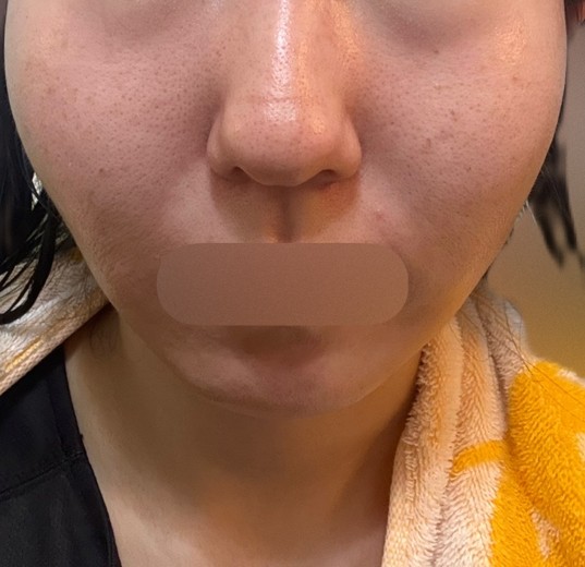 after photo: ルメッカ