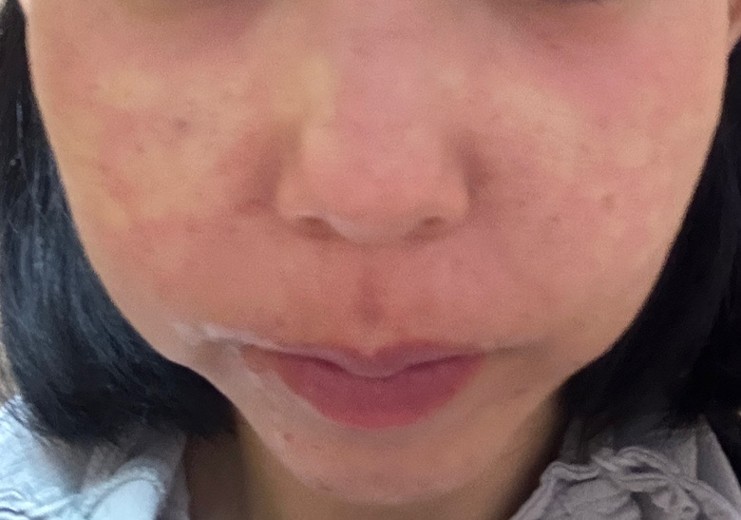 after photo: スキンボトックス, ジュベルック(Juvelook)