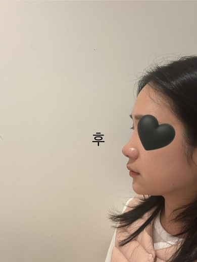 before photo: 코실리프팅