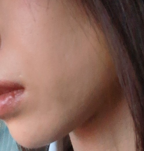 after photo: 糸リフト, メーラー/ジョール/バッカルファット除去