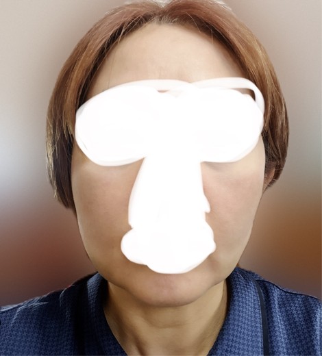 after photo: 脂肪溶解注射(顔)