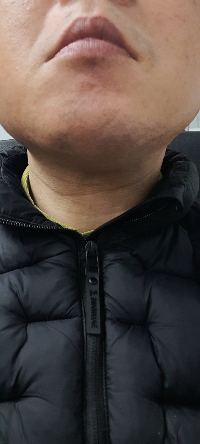 시술 전