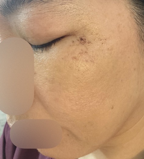after photo: ルメッカ