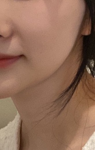 before photo: 튠페이스리프팅, 티타늄리프팅