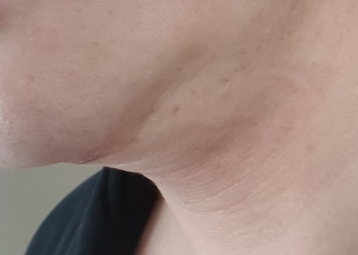 after photo: 이중턱지방흡입, 이중턱근육묶기