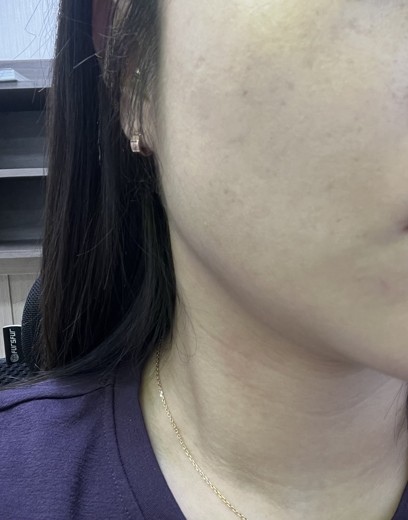 after photo: 사각턱보톡스