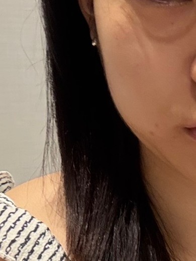 before photo: 윤곽주사