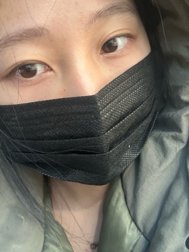 after photo: 눈밑필러