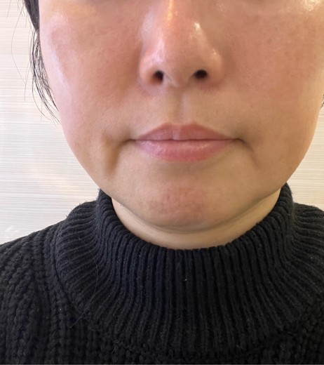 before photo: 脂肪溶解注射(太もも)