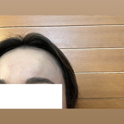 after photo: ララピール(LHAピーリング)