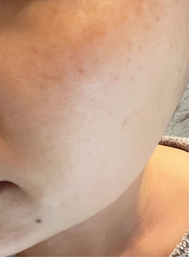 before photo: レーザーフェイシャル