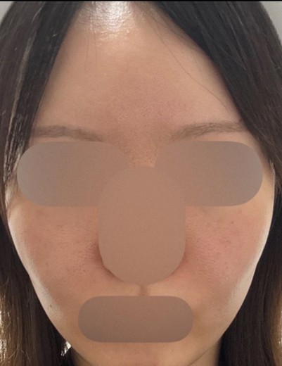 before photo: IPL(光/フォト治療), ルメッカ