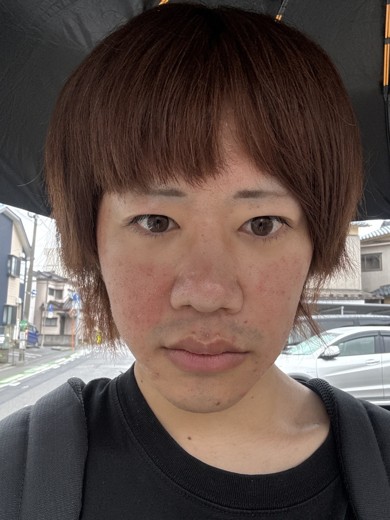 after photo: ダーマペン