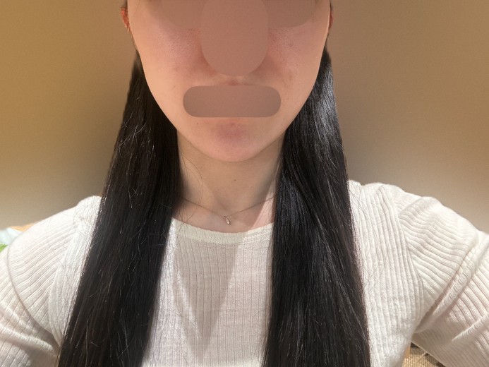 after photo: エレクトロポレーション