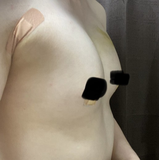 after photo: 豊胸(脂肪注入)